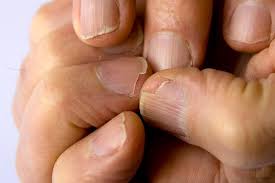 Brittle Nails Treatment
