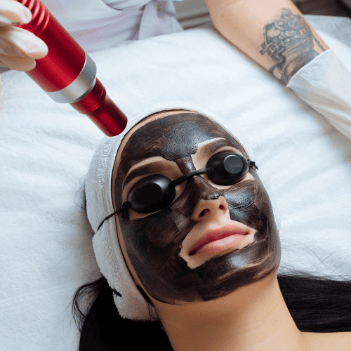 Carbon Facial / Hollywood Facial, Carbon facial treatment, Hollywood facial treatment, Laser carbon peel, Charcoal facial for glowing skin
