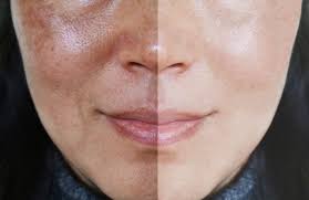 Dull look-Uneven tone Treatment
