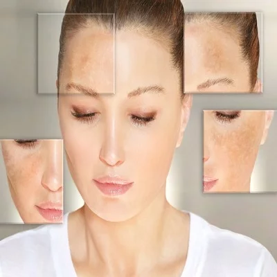 Hyperpigmentation Treatment