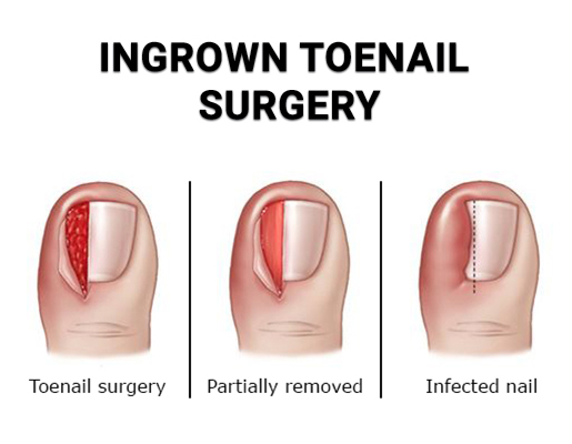 Ingrowing Nail Treatment