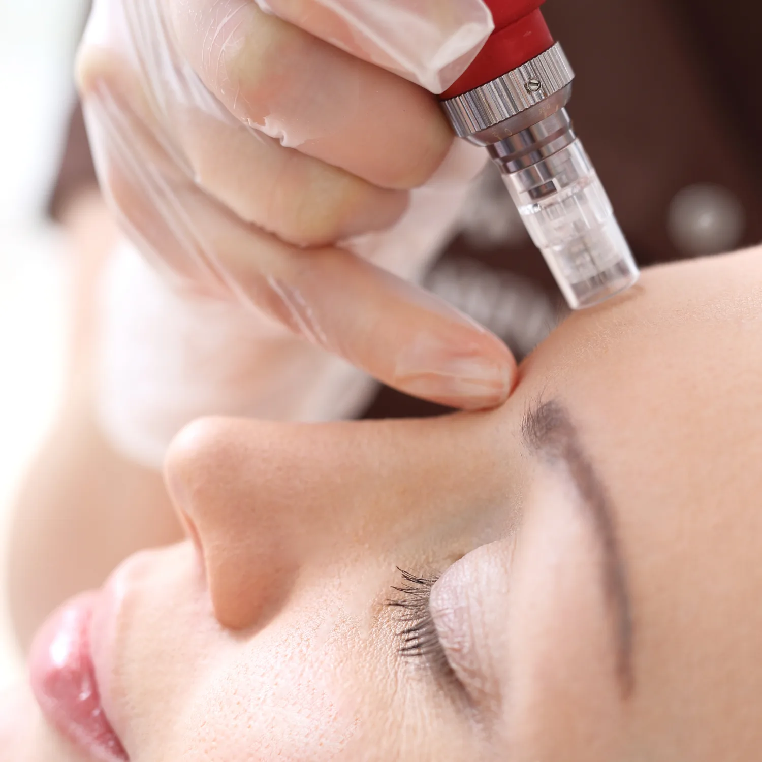 Micro Needling Treatment