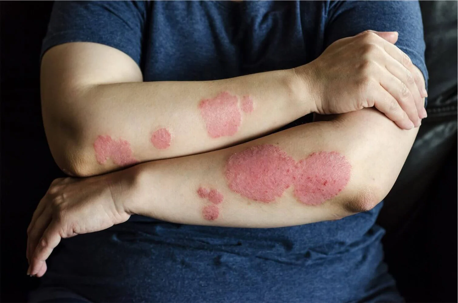 Psoriasis Treatment