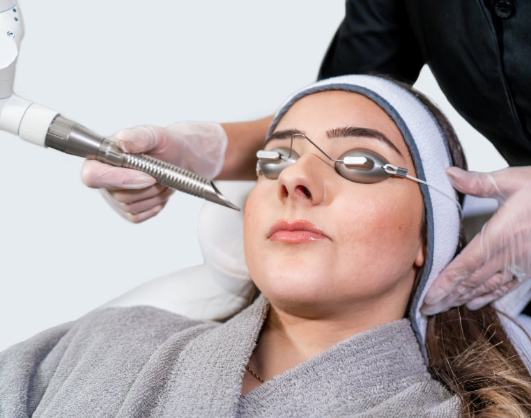 QSwitch Laser Treatment