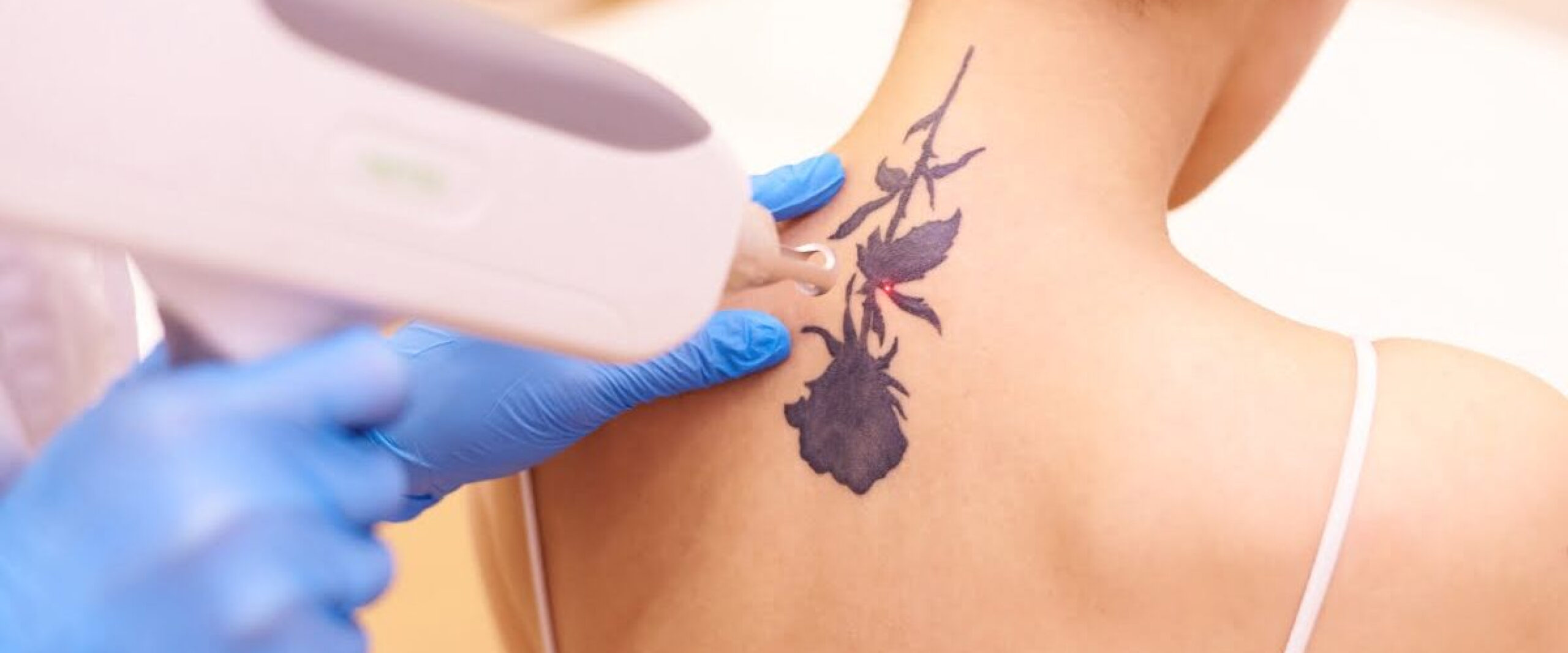 Tattoo Removal Treatment