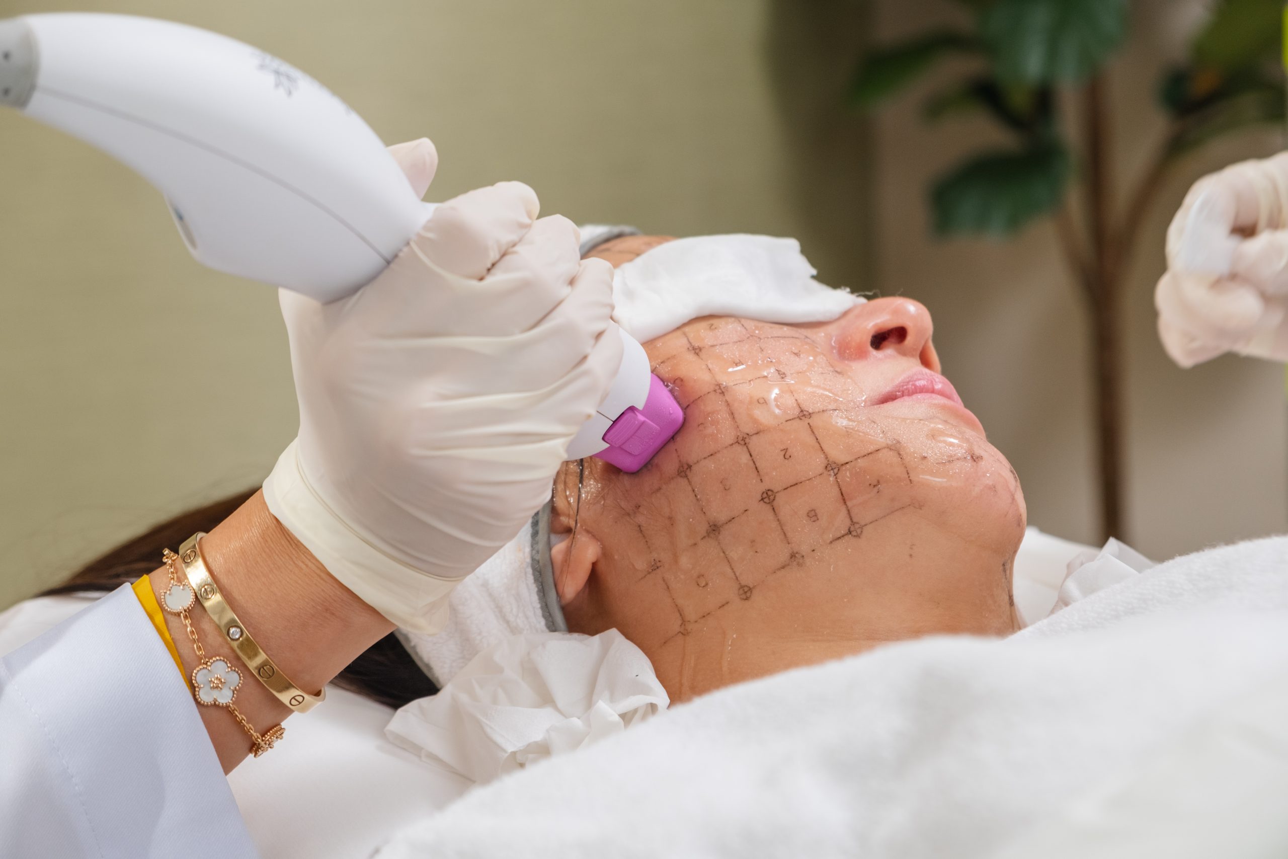 Thermage Treatment