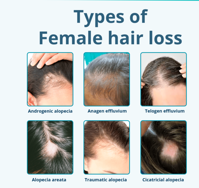 Alopecia Areata Treatment