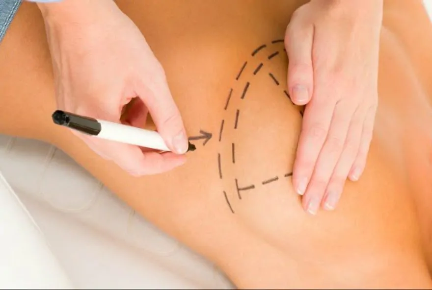 liposuction