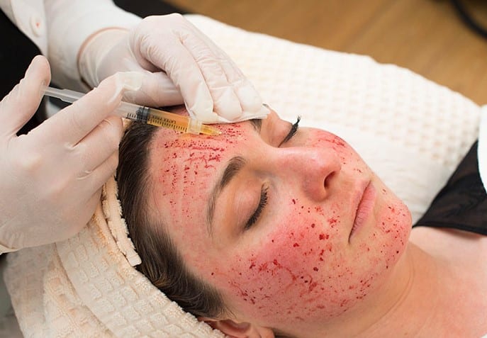 Vampire Facial Treatment