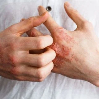 Eczema Treatment