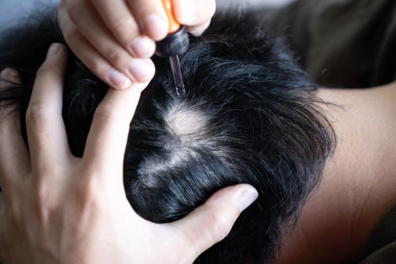 Alopecia Areata Treatment Clinic