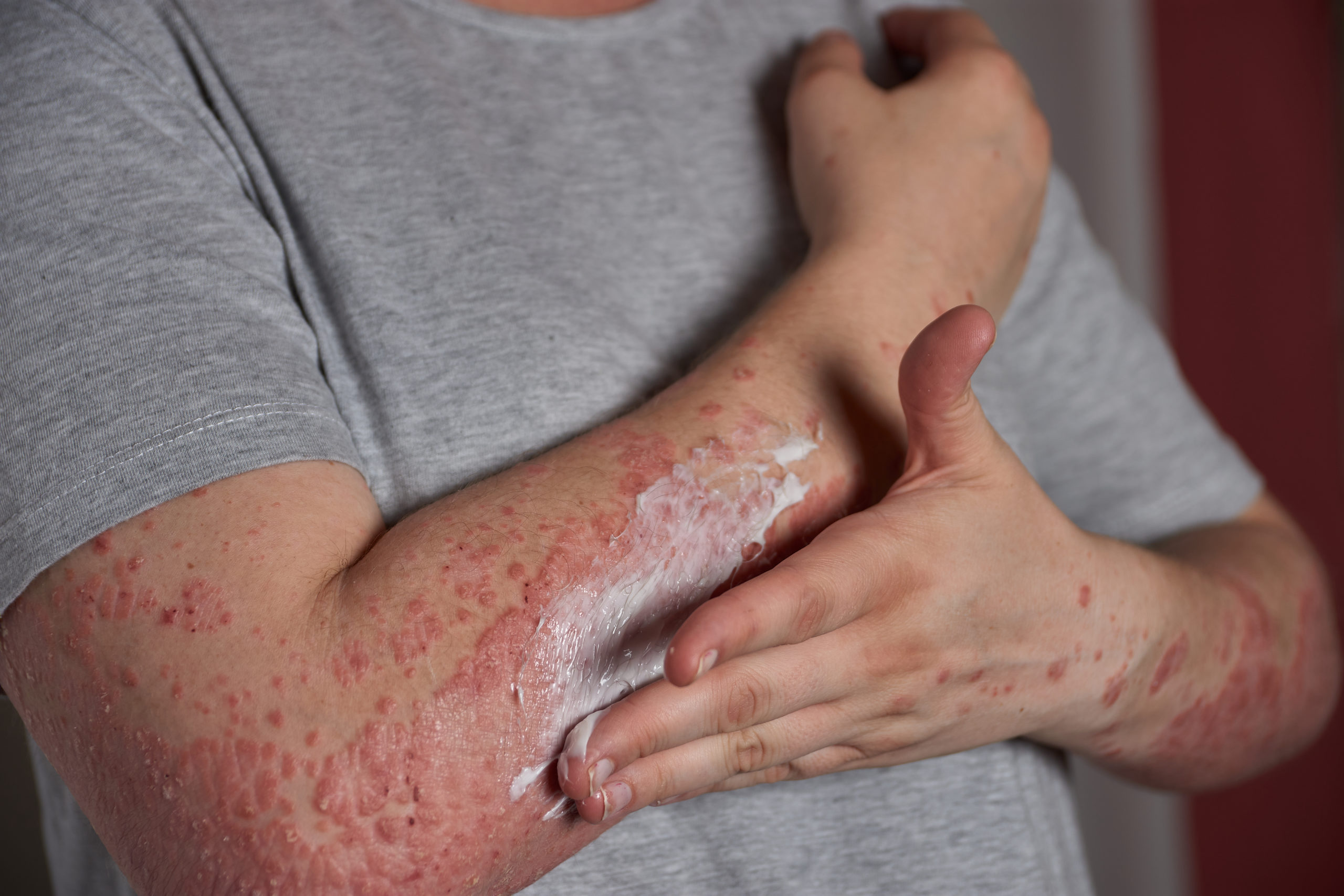 Autoimmune diseases treatment, Autoimmune disease specialist, Autoimmune therapy clinic, autoimmune condition treatment