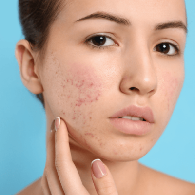 Azelaic Acid Peel Treatment