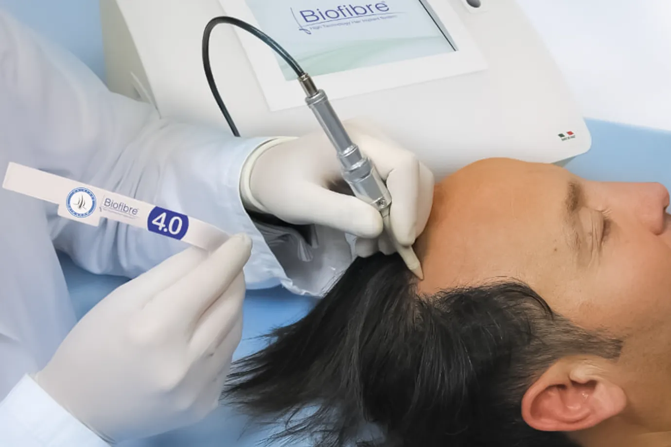 Bio Fibre Hair Implant Treatment Clinic
