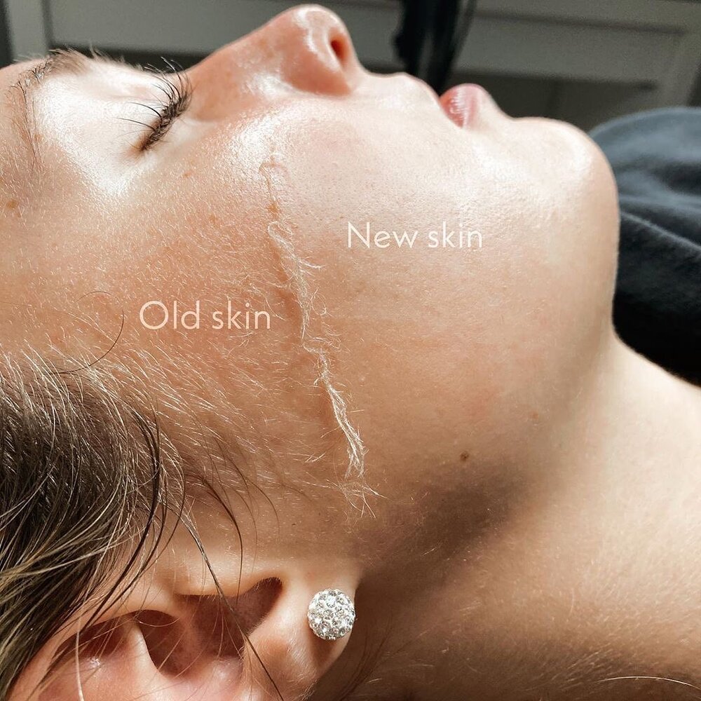 Dermaplaning Facial – Instantly Brighter, Softer Skin, Dermaplaning treatment, Dermaplaning facial, Best dermaplaning near me