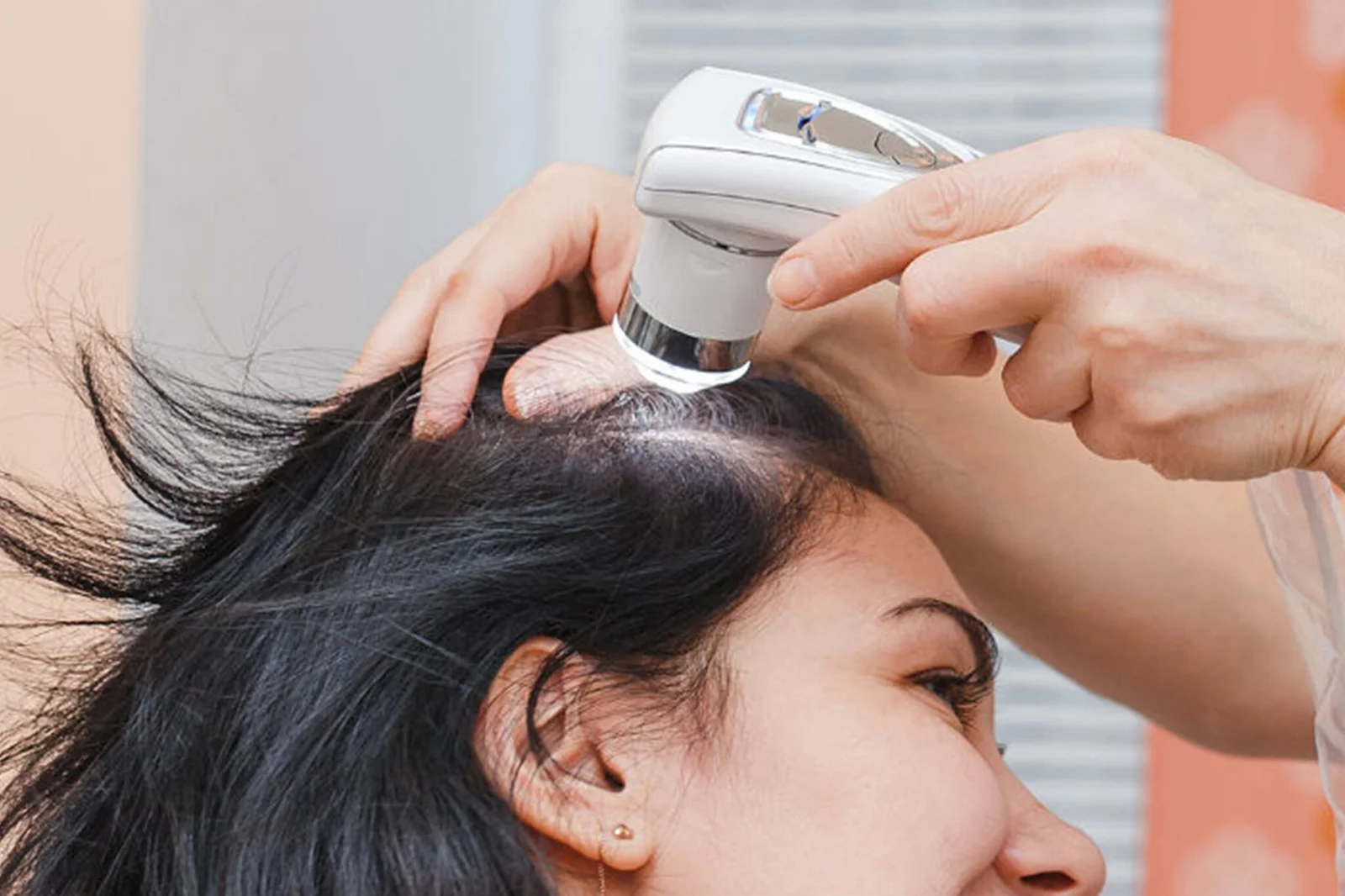 Exosome Therapy for Hair Loss – Hair Restoration, Exosome therapy for hair loss, Exosome hair regrowth, Exosome treatment for thinning hair