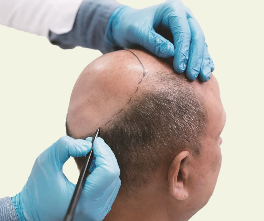 FUE-Hair-Transplantation