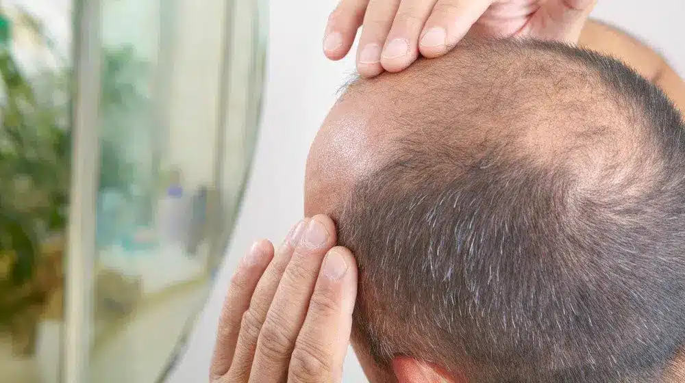 Stem Cells Treatment for Men Hair Loss, Stem cell treatment for men hair loss, Stem cell therapy for hair regrowth, Hair loss treatment for men, Male pattern baldness treatment, Stem cells for hair restoration, Hair regrowth treatment for men