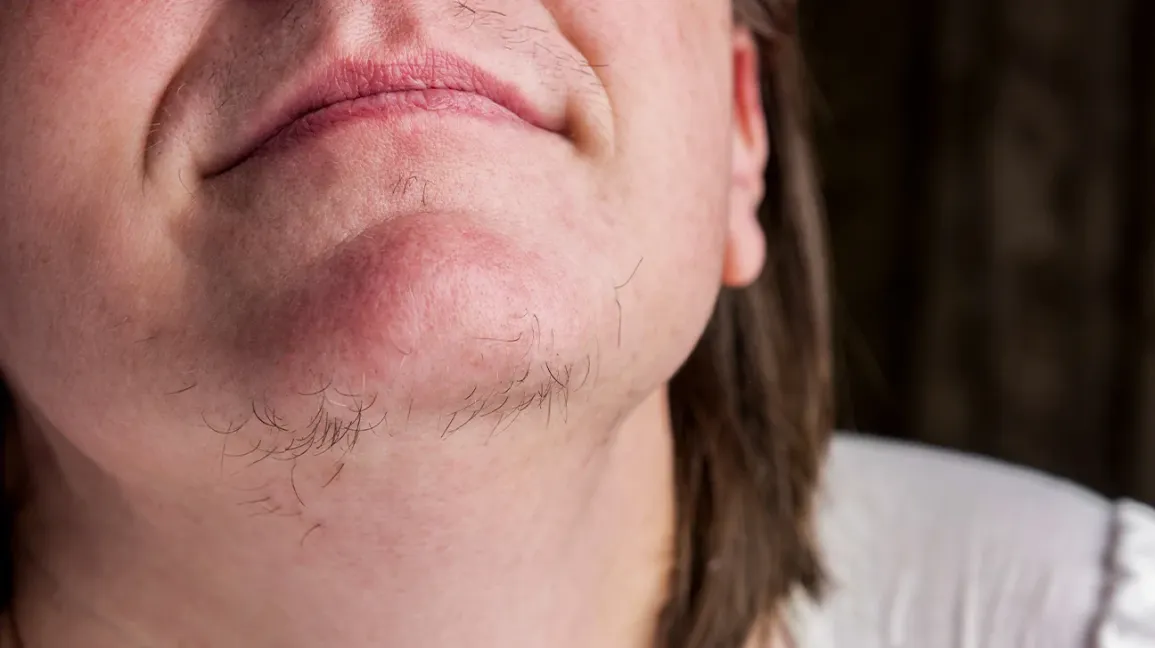 Unwanted hair growth-Hypertrichosis Treatment