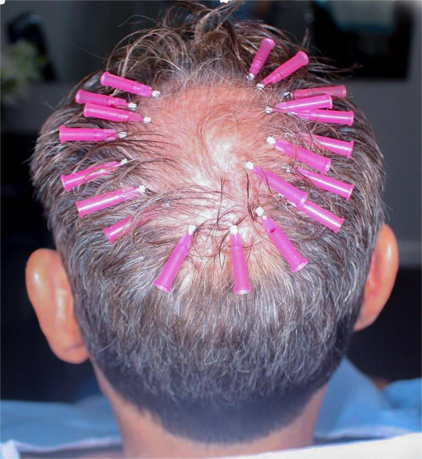 PDO Hair Thread Hair Loss Treatment for Men