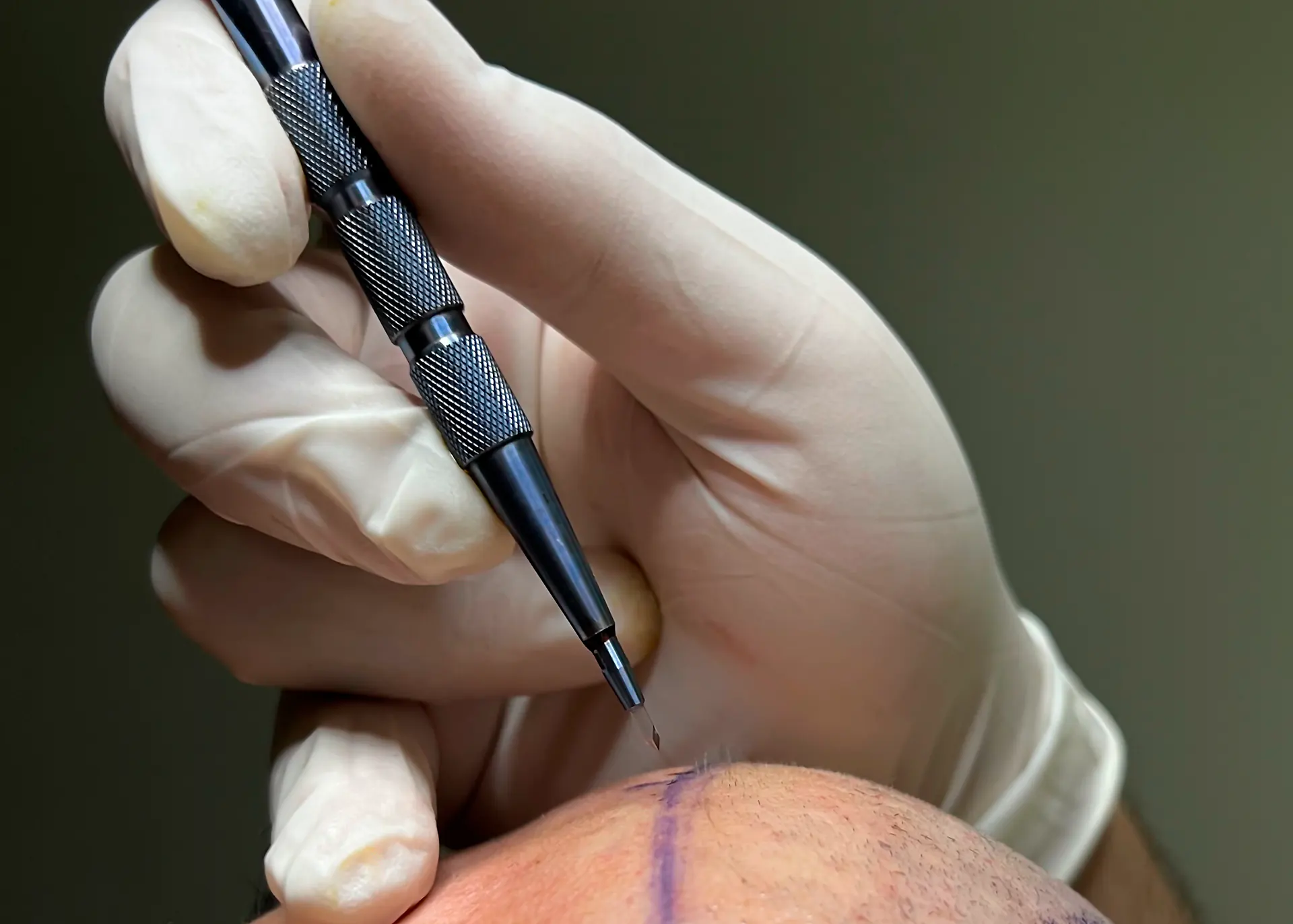 Hair Transplant - Fue Sappire Treatment, FUE Sapphire Hair Transplant, Sapphire FUE Hair Transplant Treatment
