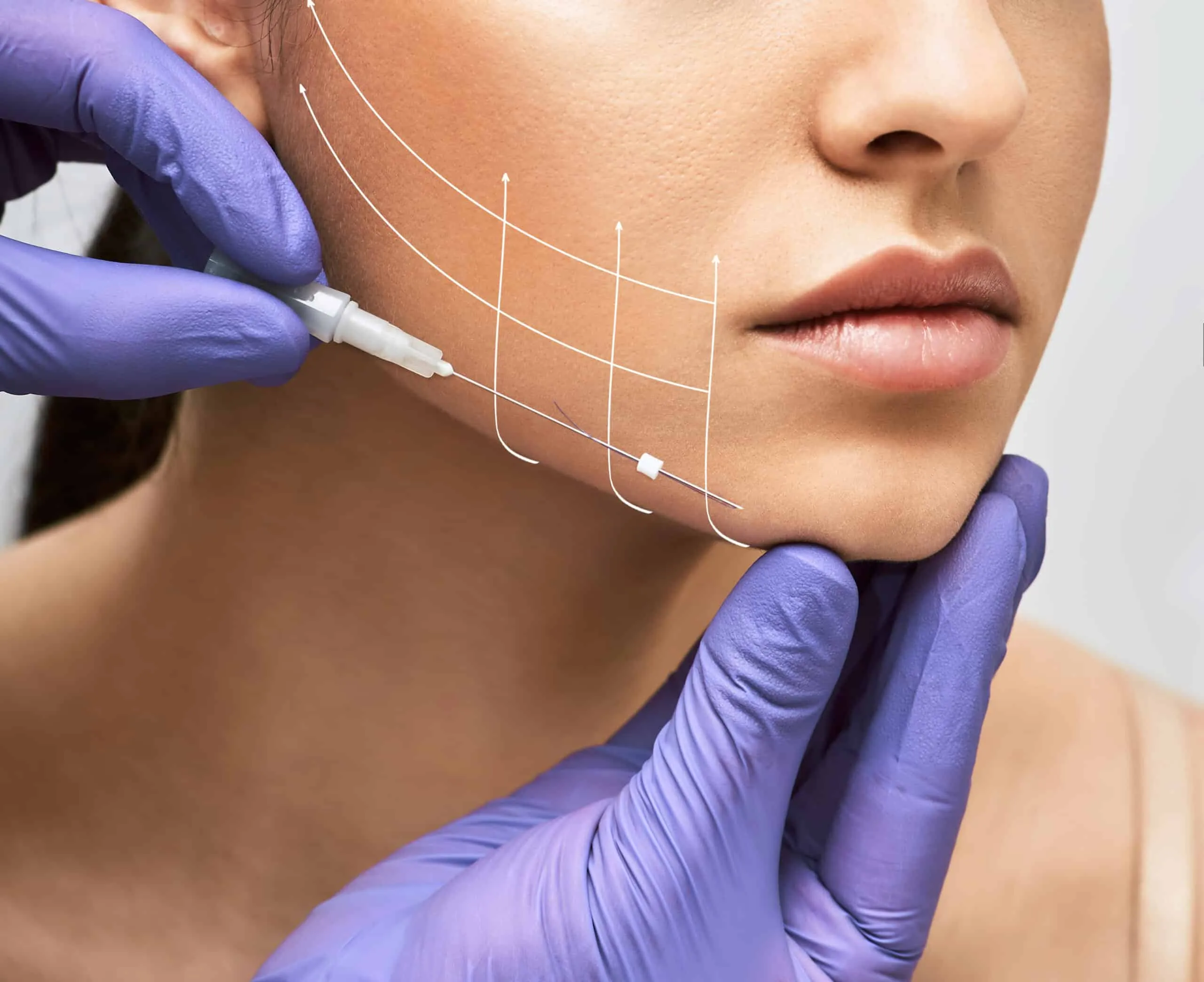 Non surgical Thread Lift Treatment, Thread lift treatment, Non-surgical facelift, PDO thread lift, Thread lift for sagging skin, Face and neck thread lift, Jawline contouring with thread lift, Thread lift near me, Skin tightening without surgery, Best thread lift clinic, Instant facial lift treatment