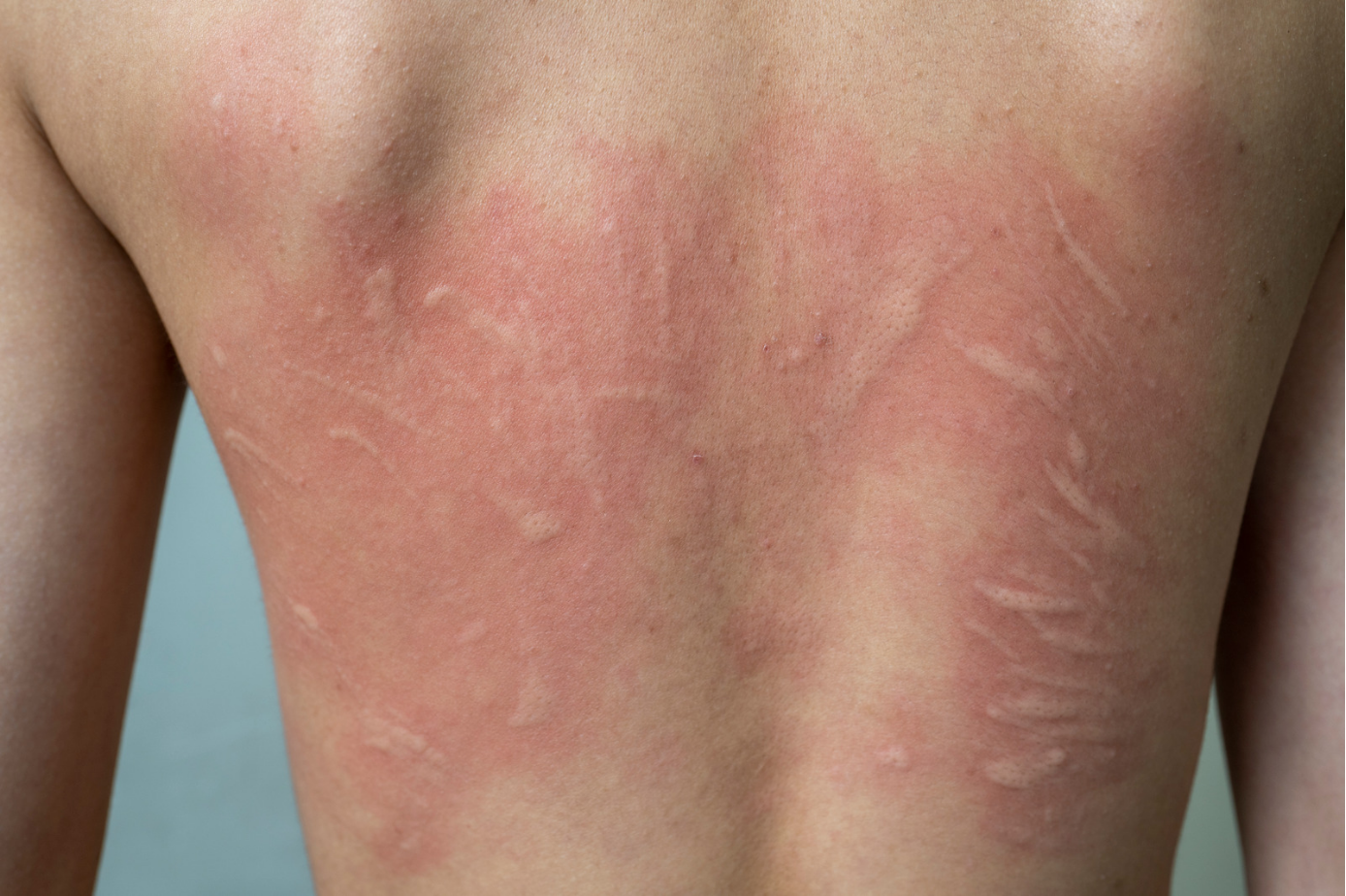 Urticaria Treatment by Expert Dermatologists, Urticaria treatment, Hives treatment, Chronic urticaria treatment, Urticaria treatment clinic, Dermatologist for urticaria, Skin allergy treatment