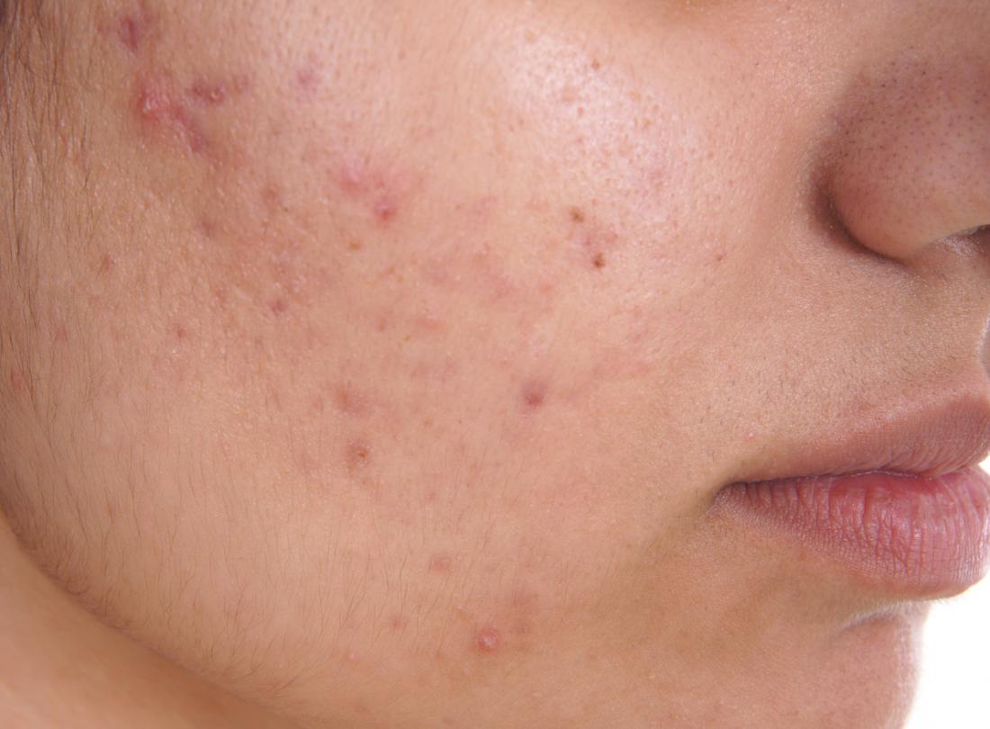 Acne Pimple Treatment Clinic