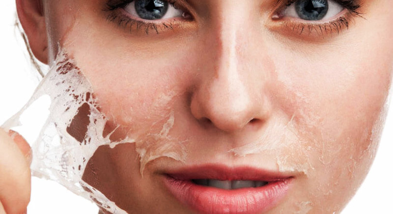 Anti Acne Peel Treatment