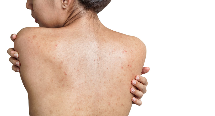 Acne-Free Back with Targeted Bacne Therapies, Back acne treatment, Bacne treatment near me, Best treatment for back acne, Clear bacne fast, Dermatologist for back acne, Acne peel for back, Laser treatment for back acne, Medicated back facial, Skincare for bacne, Back acne removal clinic