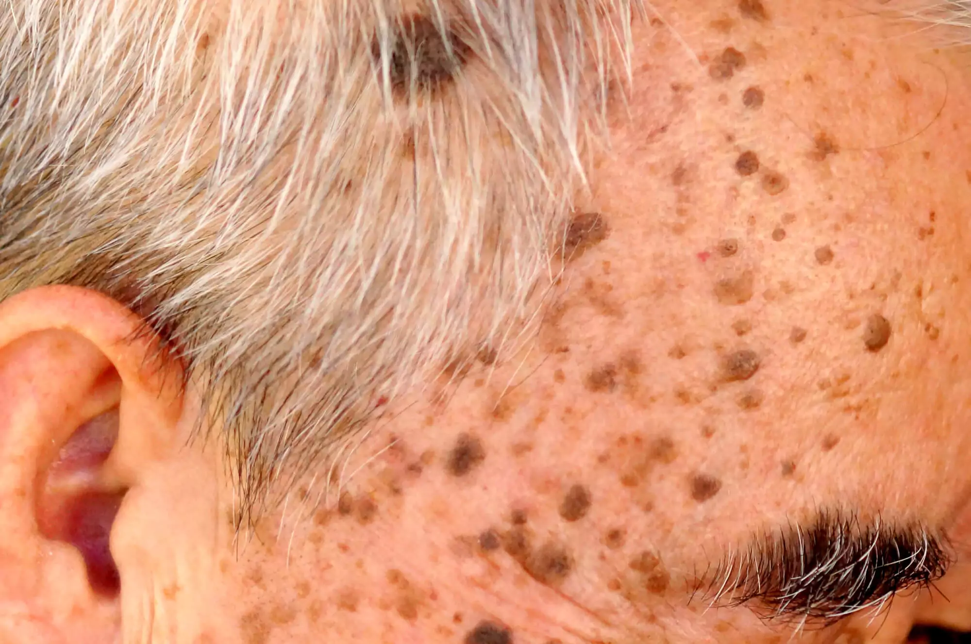 Mole removal treatment, Mole removal clinic, Mole removal dermatologist, Laser mole removal, Surgical mole removal, Safe mole removal treatment