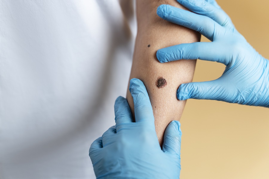 Effective Birthmarks Treatment – Safe & Advanced Solutions,Birthmarks treatment, Effective birthmark removal, Birthmark removal clinic, Laser treatment for birthmarks, Safe birthmark removal, Advanced birthmark treatment