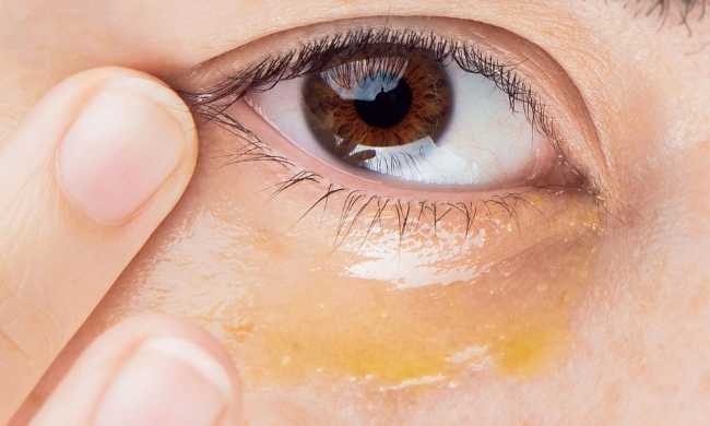 Eye peel treatment, Chemical peel for under eyes, Under-eye rejuvenation peel, Dark circle removal peel, Eye brightening peel, Eye area chemical peel