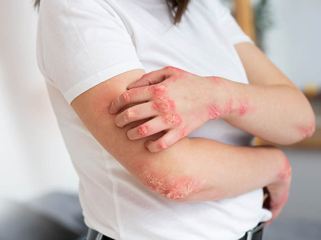 Fungal infection treatment, Skin fungal infection treatment, Antifungal treatment clinic, Fungal skin infection doctor, Best treatment for fungal infection, Dermatologist for fungal infection