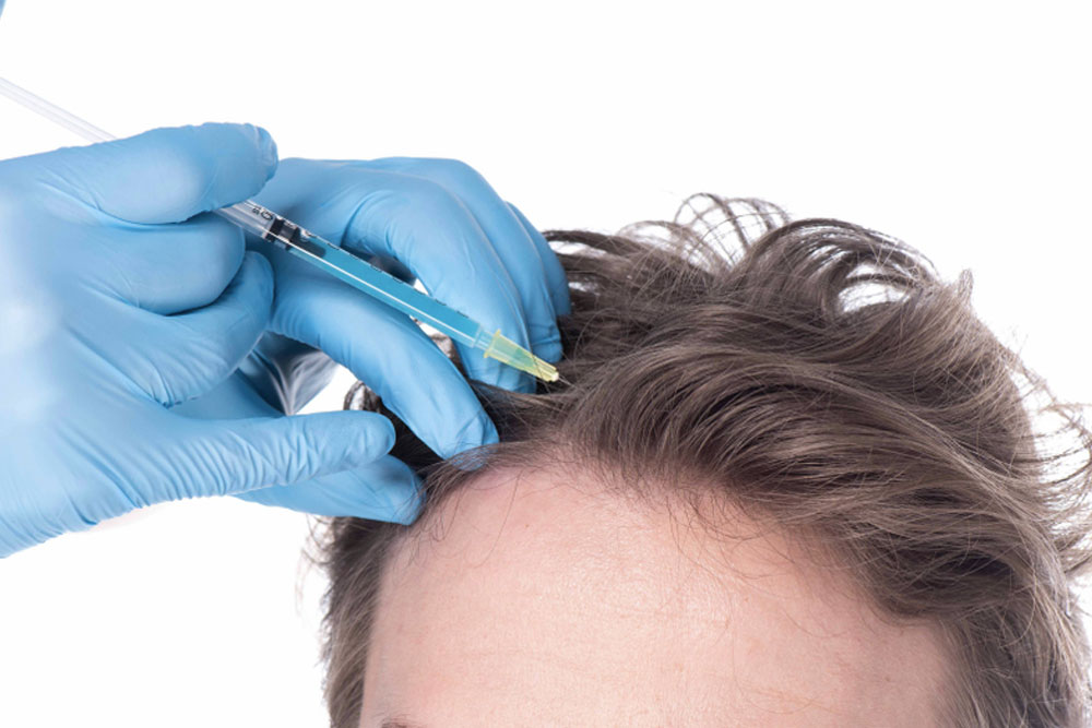 PRP Hair Treatment for Men, PRP for Male Hair Loss, PRP Hair Restoration for Men, Platelet Rich Plasma Therapy for Hair Loss in Men, Non-Surgical PRP Hair Treatment, PRP Scalp Therapy for Men