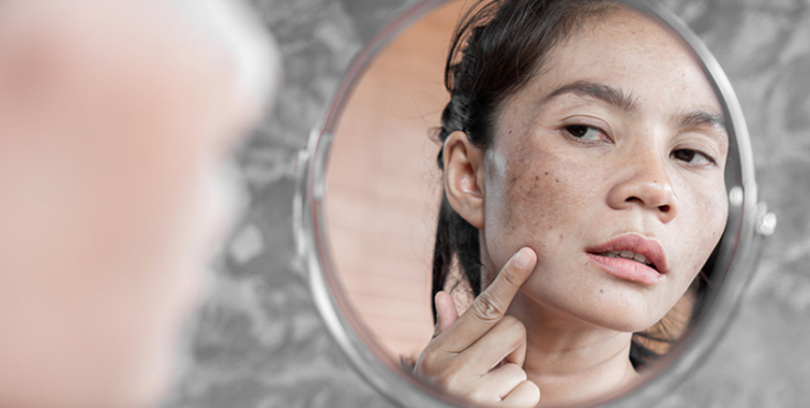 Melasma-Hyper Pigmentation Treatment, Melasma treatment, Hyperpigmentation treatment, Melasma removal therapy, Skin pigmentation treatment, , Best treatment for melasma