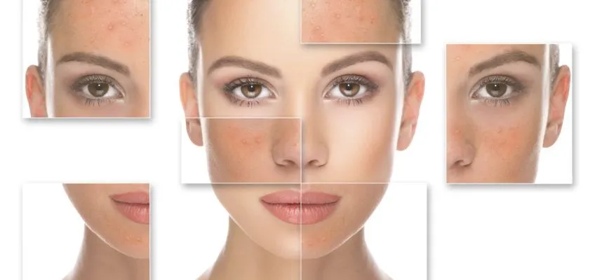 Lactic peel treatment, Lactic acid peel, Lactic acid chemical peel, Lactic peel for glowing skin, Lactic peel for dry skin, Gentle exfoliating peel