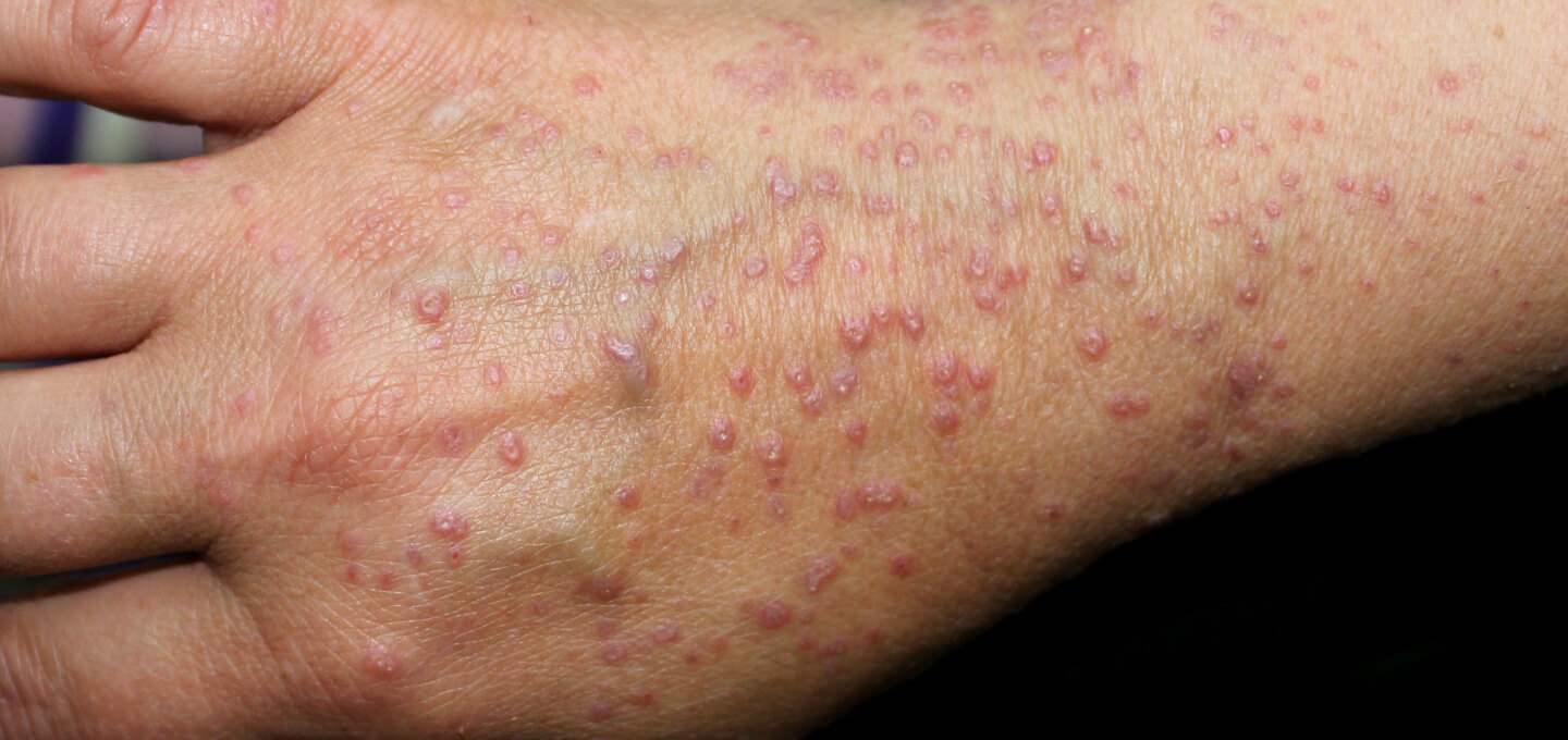 Lichen Planus treatment, Lichen Planus specialist, Lichen Planus skin treatment, Oral Lichen Planus management, Lichen Planus dermatology clinic, Best treatment for Lichen Planus