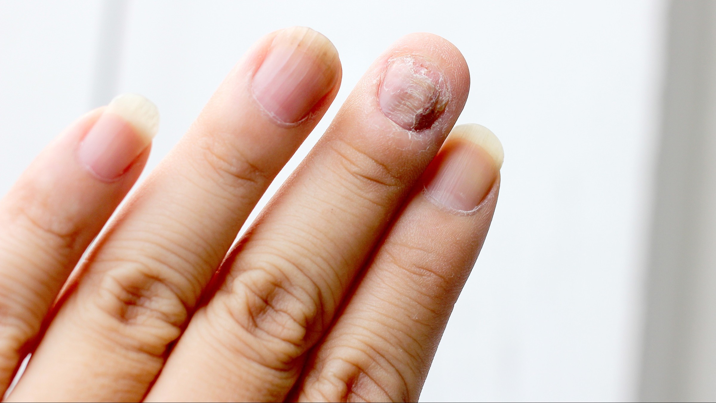 Nail Fungus (Onychomycosis) Treatment, Nail fungus treatment, Onychomycosis treatment, Fungal nail infection treatment, Toenail fungus treatment, Fingernail fungus treatment, Best treatment for nail fungus