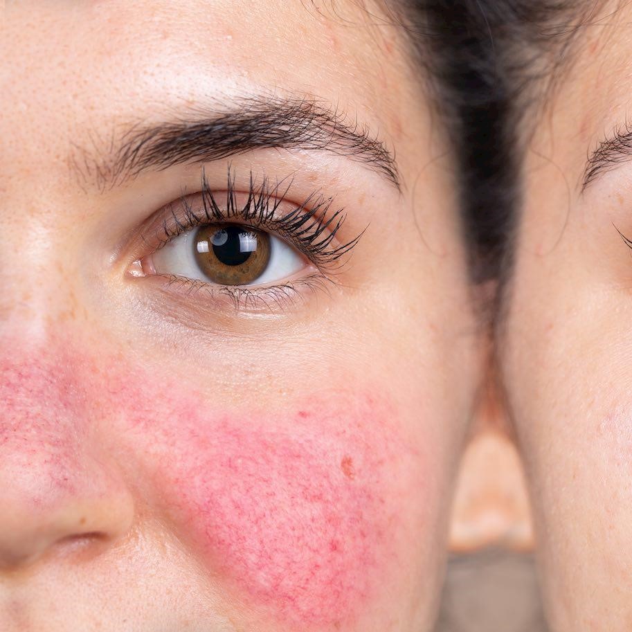 Rosacea treatment clinic, Rosacea dermatologist, Treatment for rosacea, Rosacea skin treatment, Best clinic for rosacea, Rosacea skin care clinic