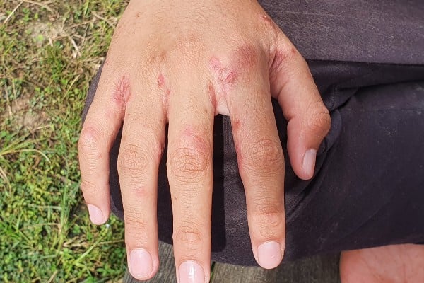 Scabies and Pediculosis Treatment, Scabies Treatment, Pediculosis Treatment, Scabies and Lice Treatment, Scabies Skin Infection Treatment, Head Lice Treatment, Body Lice Treatment, Medical Treatment for Scabies, Dermatologist for Scabies and Lice
