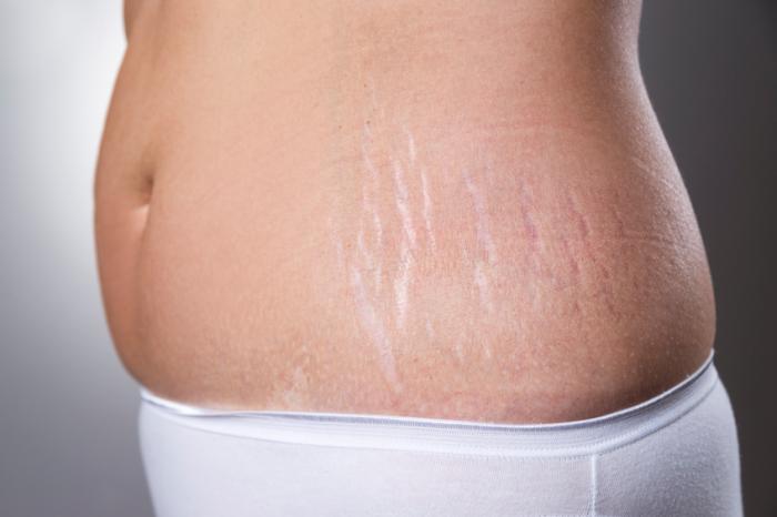 Stretch mark treatment, Stretch mark removal, Stretch mark reduction, Laser treatment for stretch marks, Best clinic for stretch mark removal, Dermatologist for stretch marks